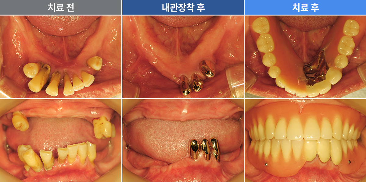 전영미